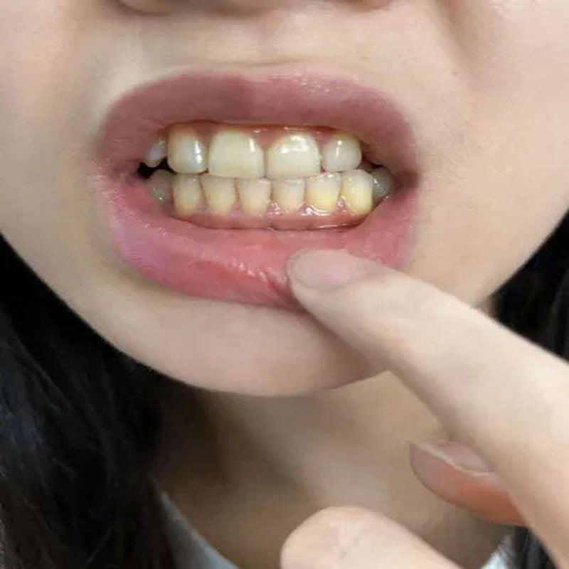 Dr.ville Niacinamide Toothpaste Removal Yellow Stains ( BUY 1 GET 1 FREE )