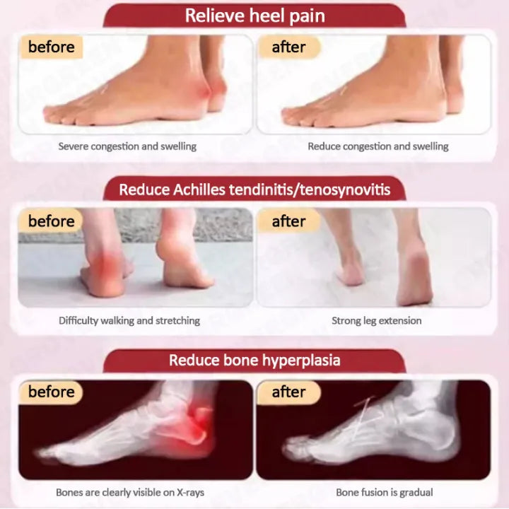 Plantar Fasciitis Heel Pain Spray (BUY 1 GET 1 FREE)