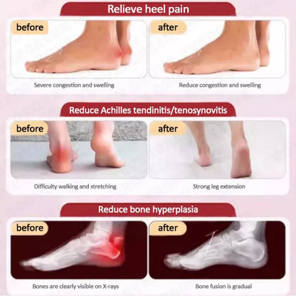 Plantar Fasciitis Heel Pain Spray (BUY 1 GET 1 FREE)