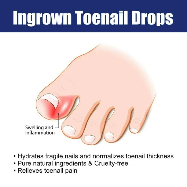 Ingrown Toenail Drops Softens Nail & Pain Reliever ( BUY 1 GET 1 FREE )