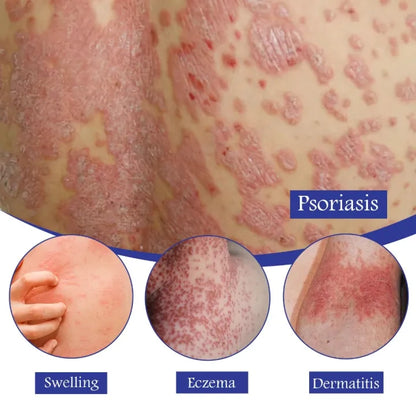 Imported japan Psoriasis Anti - Itch Spray