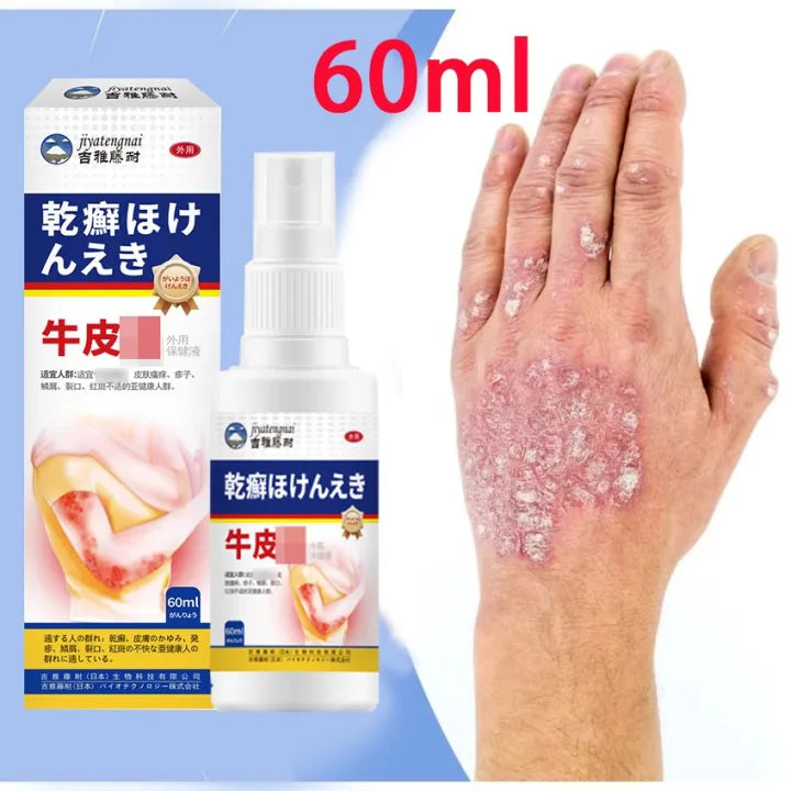 Imported japan Psoriasis Anti - Itch Spray