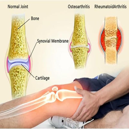 OUHOE Bee Venom Cream (BUY 1 GET 1 FREE)