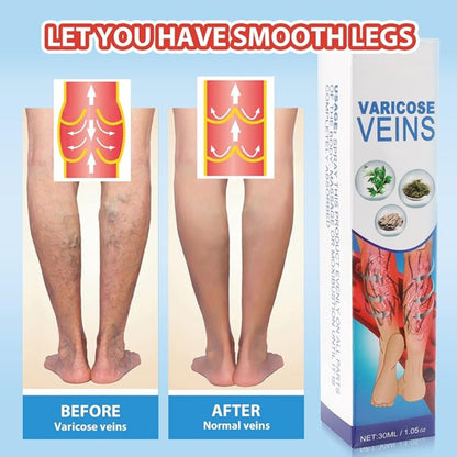 💜 South Moon VeinHealing™ Varicose Veins Spray🌿💦
