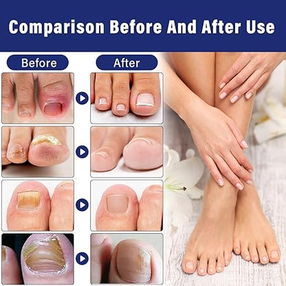 Ingrown Toenail Drops Softens Nail & Pain Reliever ( BUY 1 GET 1 FREE )