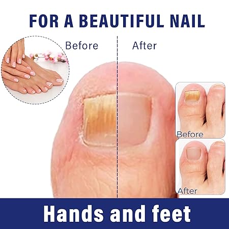Ingrown Toenail Drops Softens Nail & Pain Reliever ( BUY 1 GET 1 FREE )