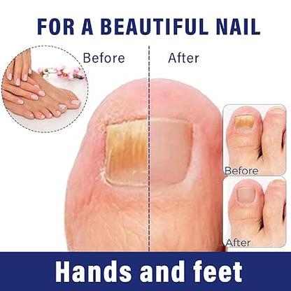 Ingrown Toenail Drops Softens Nail & Pain Reliever ( BUY 1 GET 1 FREE )