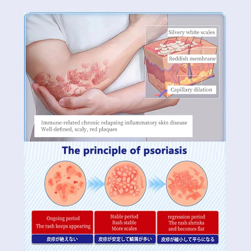 Imported japan Psoriasis Anti - Itch Spray