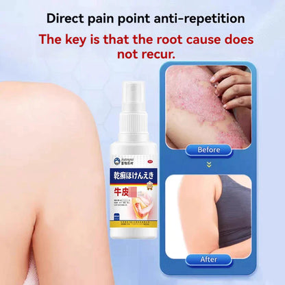 Imported japan Psoriasis Anti - Itch Spray