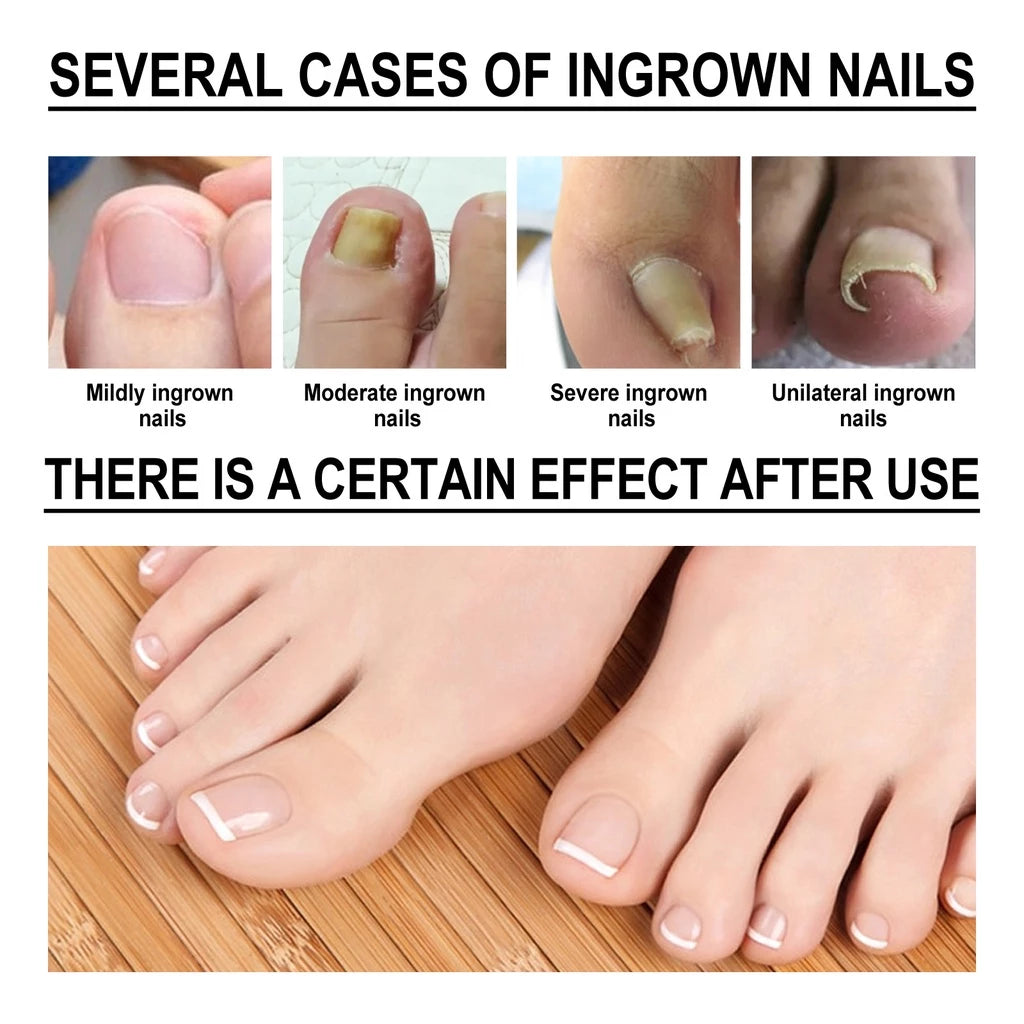 SouthMoon Ingrown Toenail Drops Nail Fungal Repair( BUY 1 GET 1 FREE)
