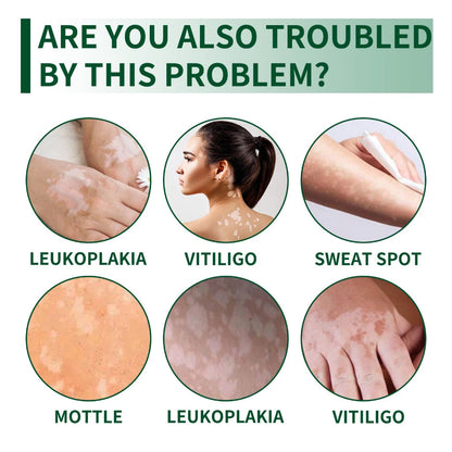 Herbal Vitiligo White Spot Remove Cream ( BUY 1 GET 1 FREE )