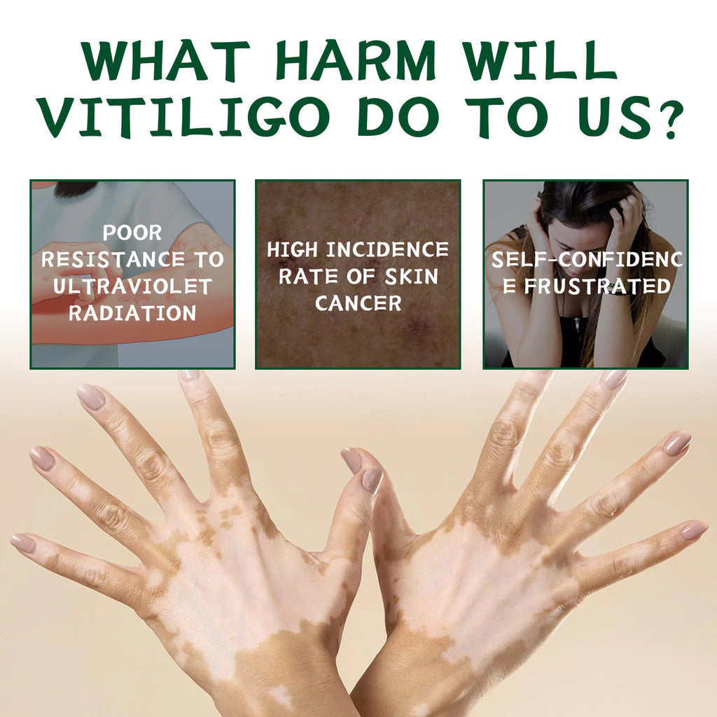 Herbal Vitiligo White Spot Remove Cream ( BUY 1 GET 1 FREE )
