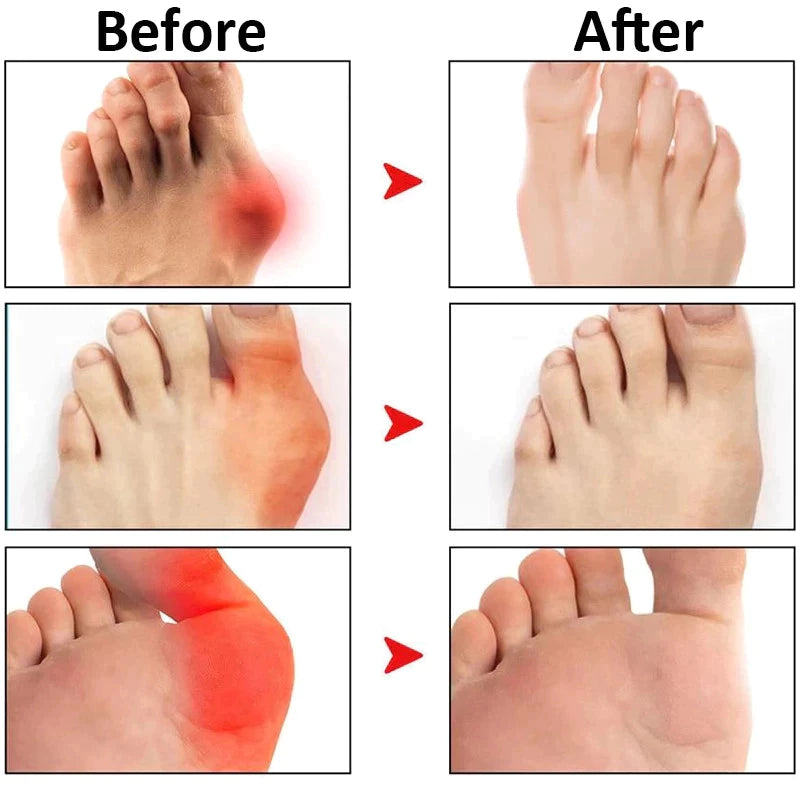 Japan Gout Medicine Patch pack of 12 pcs ( BUY 1 GET 1 FREE )